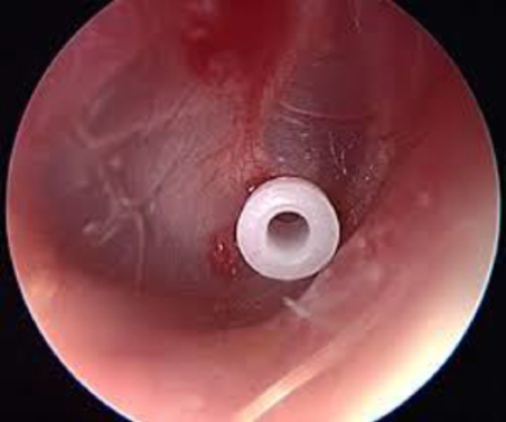 Ear grommet